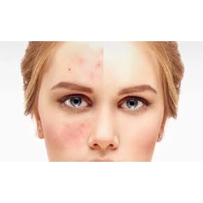 ✅ TRETINOIN ARET 0.1% , 0.05% , 0.025% 20g GIẢM MỤN MỜ THÂM CHỐNG LÃO HÓA