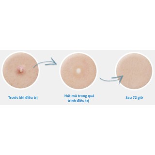 Miếng dán hút mụn Hàn Quốc