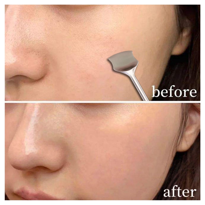 Dụng Cụ Nặn Mụn Đầu Đen Bằng Thép Không Gỉ Chuyên Nghiệp