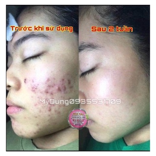 [FREESHIP] [CHÍNH HÃNG] Kem Mụn Thảo Dược Hoa Đào 2 weeks