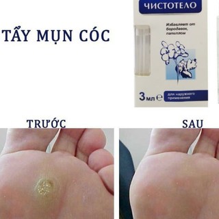 Gel tẩy nốt ruồi,Chấm Mụn thịt, Mụn ruồi, Nốt Ruồi, Mụn cóc (Nga) 50k freeship 15k ( xem hình cuối)