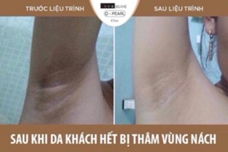 Kem trị thâm Juihe Q – Pearl