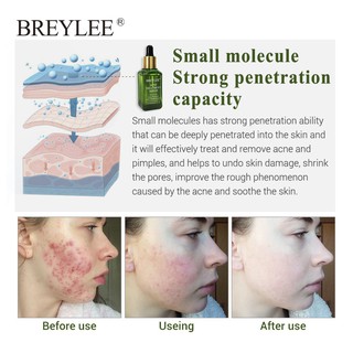 Serum Hỗ Trợ Giảm mụn BREYLEE 17ml