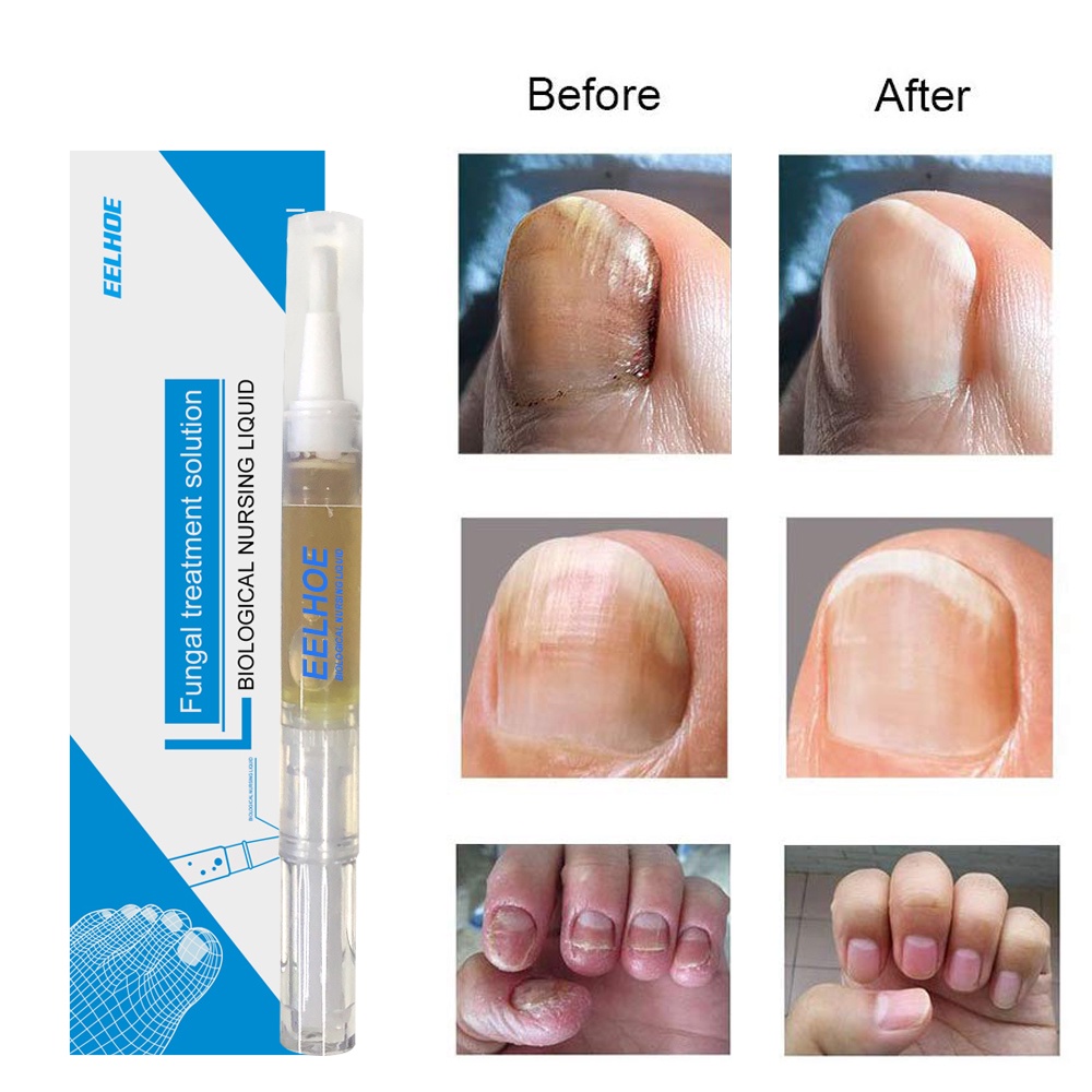 1 Cây Bút Dầu Trị Nấm Móng Tay / Móng Chân / Móng Chân Chăm Sóc Sức Khỏe Hiệu Quả 3ML