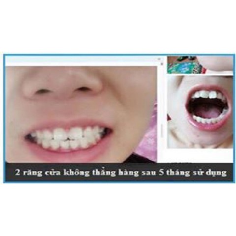 Bộ niềng răng tại nhà cho bé từ 6-15 tuổi A1+A2+A3