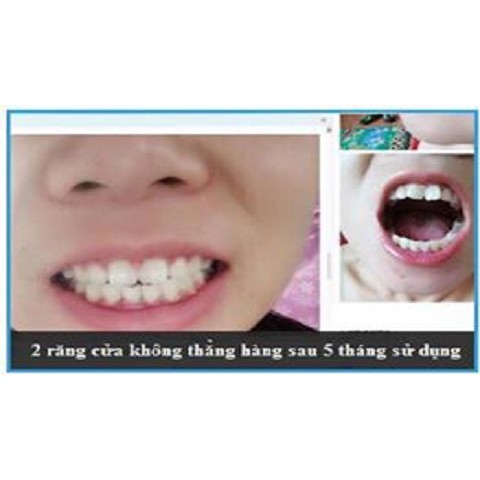 Bộ niềng răng tại nhà cho bé từ 7-12 tuổi| A1+A2