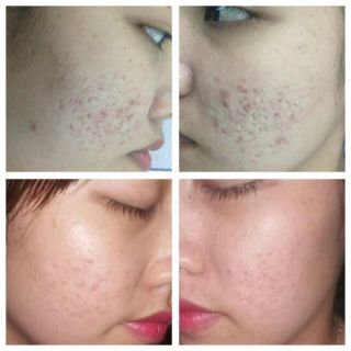 Serum Sẹo Rỗ Sẹo Lõm Cao Cấp