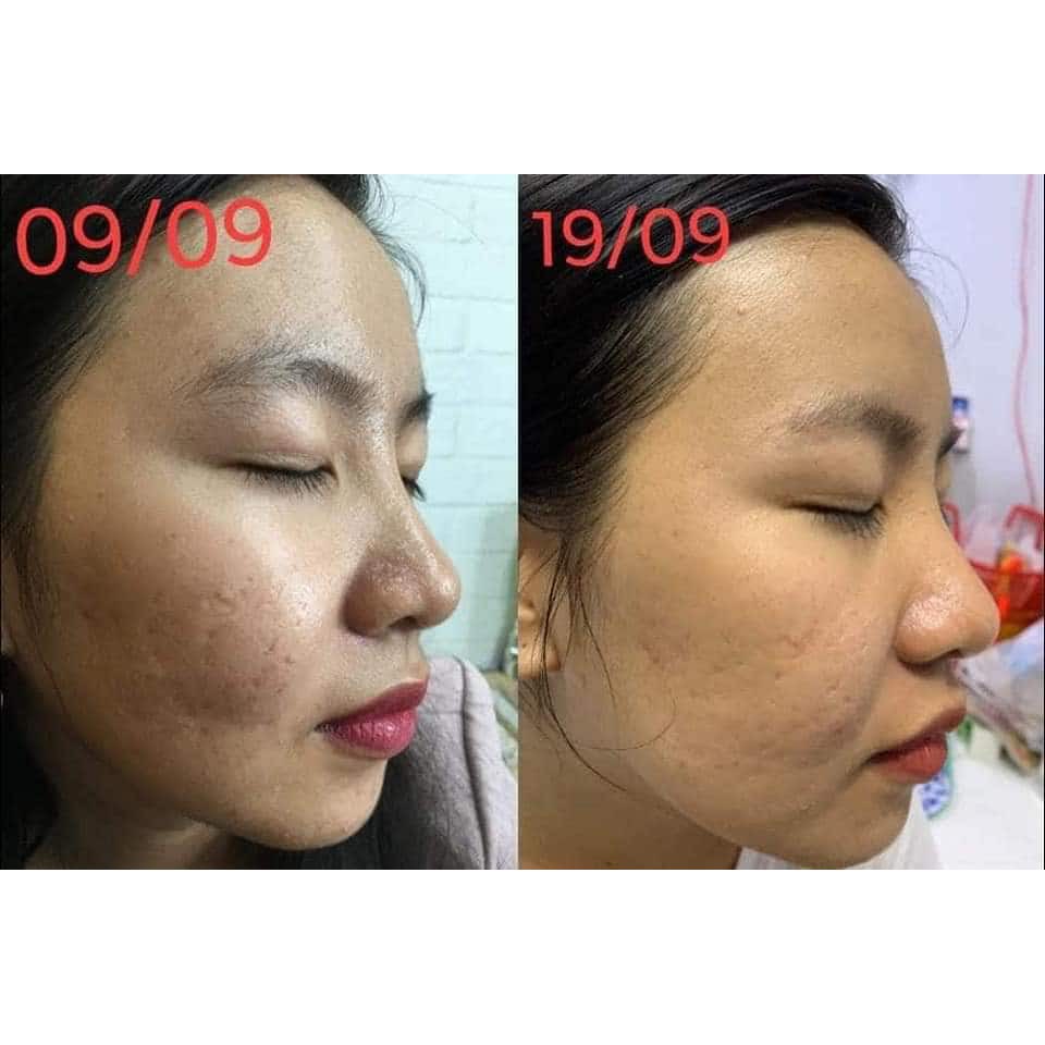 Serum Giảm Mụn Thâm Sẹo Rỗ Huyết Hồng Sâm 10ml Cam Kết Không Sưng Không Đỏ Hiệu Quả Ngay Lọ Đầu Tiên