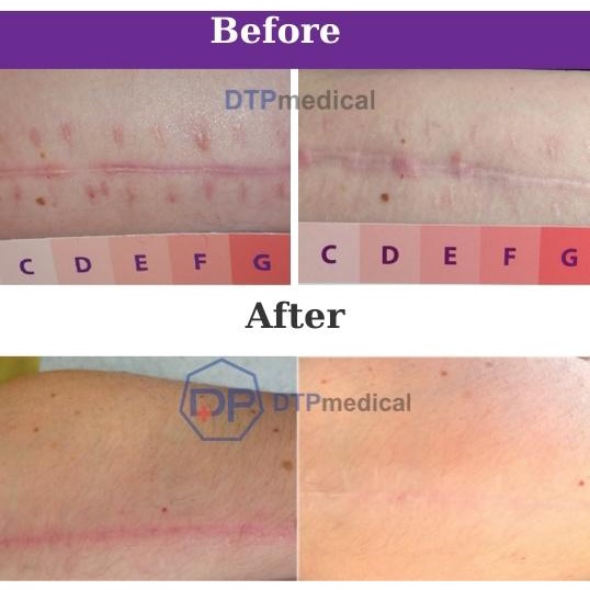 Kem xóa sẹo lồi, sẹo phì đại, sẹo bụng sau khi phẫu thuật, Gel Bapscarcare làm phẳng, làm mềm và mờ sẹo lâu năm hiệu quả