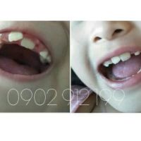 (A1+A2) Dụng cụ niềng răng cho trẻ em