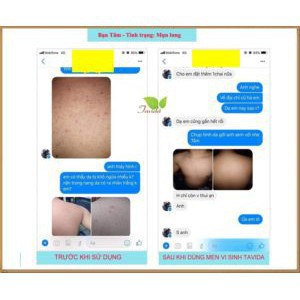 [5 Chai] MEN VI SINH TAVIDA HẾT MỤN LƯNG, VIÊM NANG LÔNG, MẨN NGỨA | BigBuy360 - bigbuy360.vn