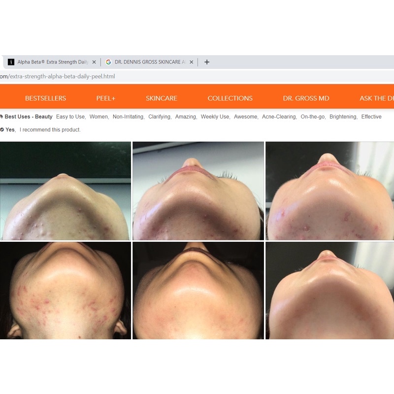 Tẩy da chết và tái tạo da Dr. Dennis Gross Skincare Alpha Beta® Peel Extra Strength Daily Peel