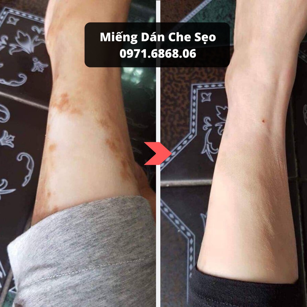 Miếng dán che khuyết điểm che sẹo Nhật bản che sẹo lồi sẹo lõm sẹo thâm tiệp màu da, nhiều size