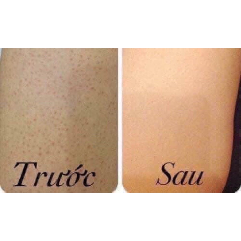 LOTION KELLA VIÊM LỖ CHÂN LÔNG,  VIEM DA THÁI LAN