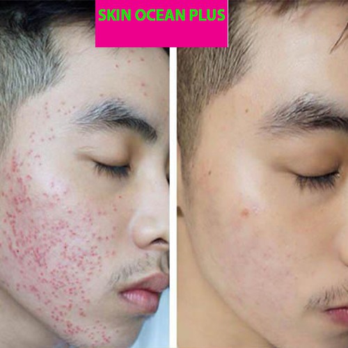 [DR MAI] SERUM MỤN QUYỀN NĂNG SKIN OCEAN PLUS, MỤN HẾT >99% TÌNH TRẠNG MỤN TRÊN DA. CAM KẾT MỤN GÌ CŨNG HẾT. | BigBuy360 - bigbuy360.vn