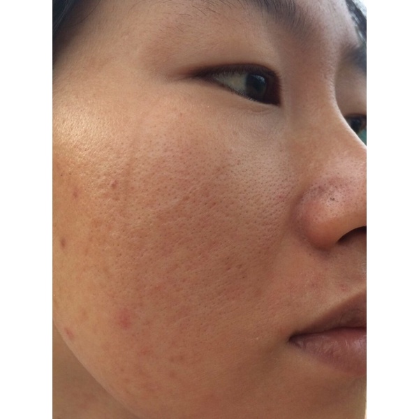 Serum thảo dược mụn may new tái tạo da