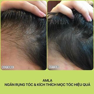 (Giá sốc) Dầu gội trị rụng tóc- kích mọc tóc Amla