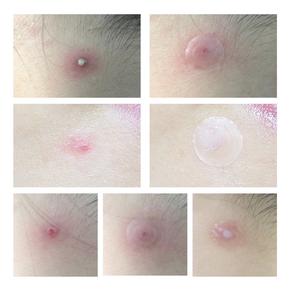 Bộ 25 miếng dán mụn vô hình LANBENA thoáng khí giúp chăm sóc làm dịu phục hồi làn da mặt sử dụng hàng ngày | BigBuy360 - bigbuy360.vn