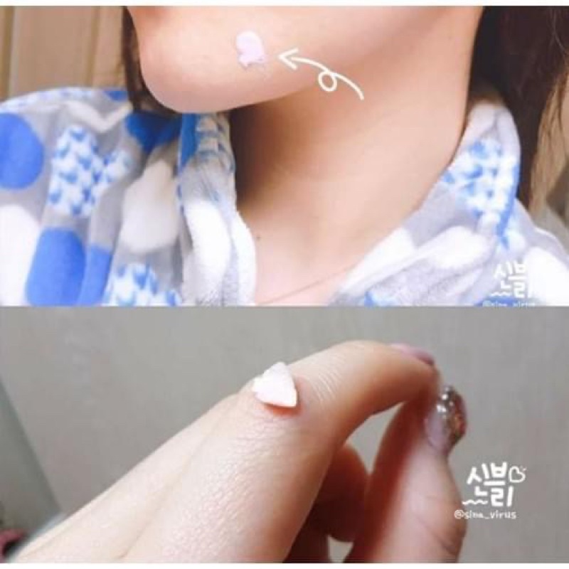 Kem Dưỡng Giảm Mụn Viêm, Mụn Sưng Mủ, Mờ Thâm, Mờ Sẹo, Giảm Mụn Ẩn G9Skin Calamine Gel Spot Patch LOVESKINCARE VN