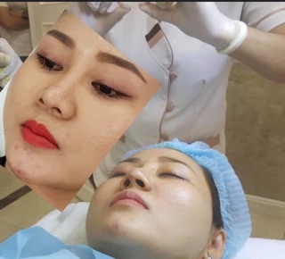 Chỉ nâng mũi- chỉ hiko- chỉ collagen