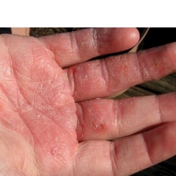 THẢO DƯỢC HẾT BAY BONG TRÓC DA NGÓN TAY, LÒNG BÀN TAY, BÀN CHÂN