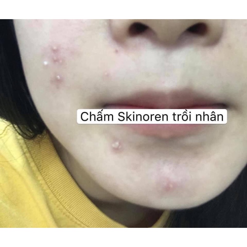 GEL SKINOREN Bayer 15% AZELAIC ACID ( Bill) | BigBuy360 - bigbuy360.vn