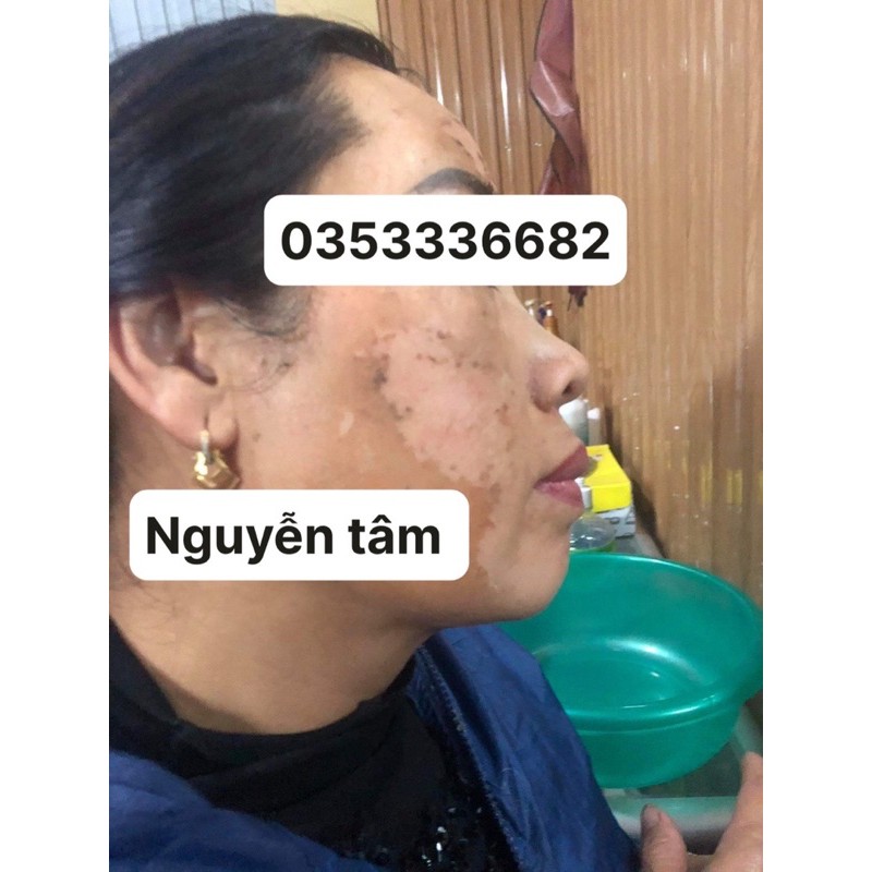 NANO PEEL PLUS ( siêu vi kim tinh thể kim cương nano peel plus) mua 1 tăng 1 kem chống nắng gogreen