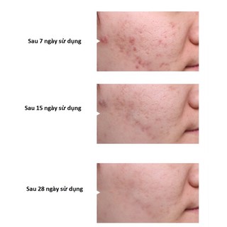 Serum Giảm Mụn Mờ thâm dưỡng trắng da