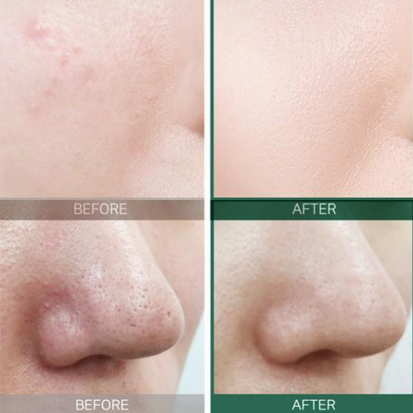 [ SỈ TỪ 206K ] Tinh Chất Trị Mụn Some By Mi AHA-BHA-PHA 30 Days Miracle Serum 50ml | BigBuy360 - bigbuy360.vn