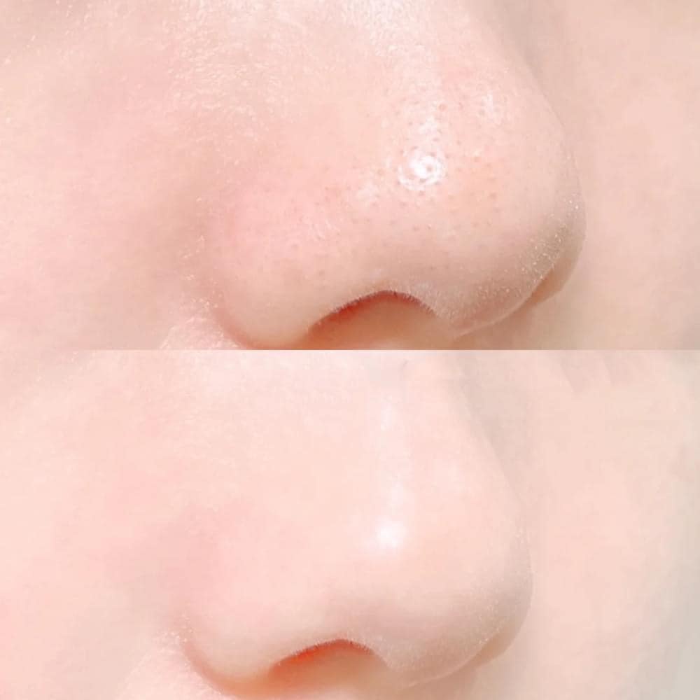 Lẻ Mặt nạ miếng dán đẩy mụn lột mụn đầu đen Good bye Blackhead Ciracle