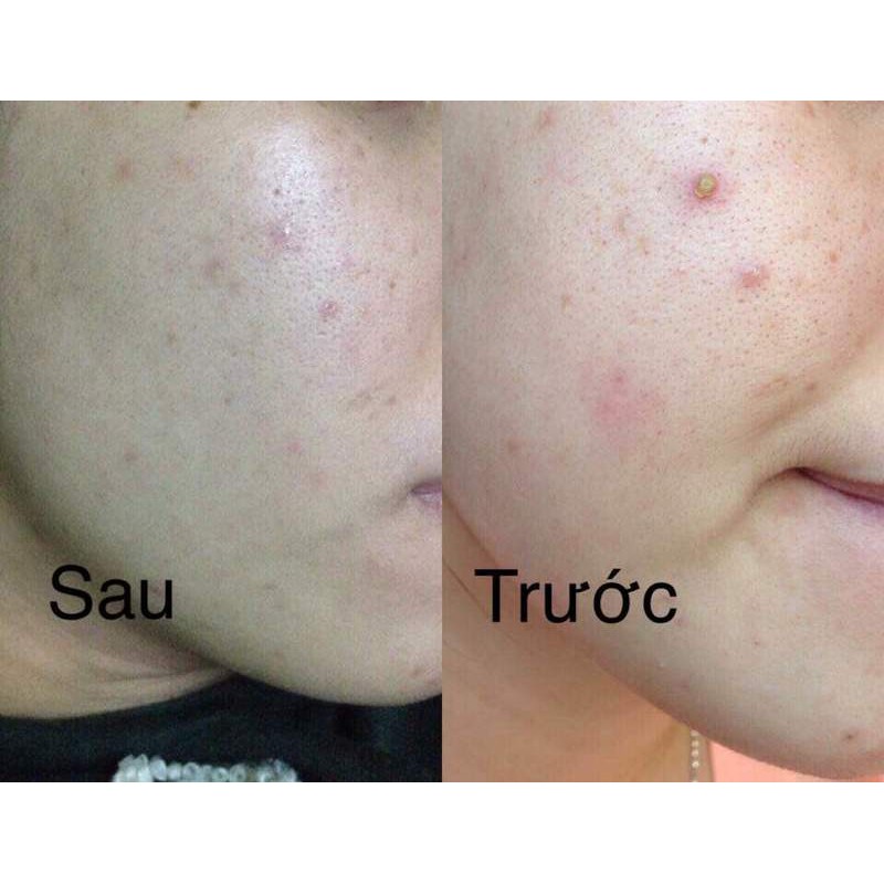 Kem Pair Acne Hỗ Trợ Làm Giảm Và Loại Bỏ Mụn Nhật Bản