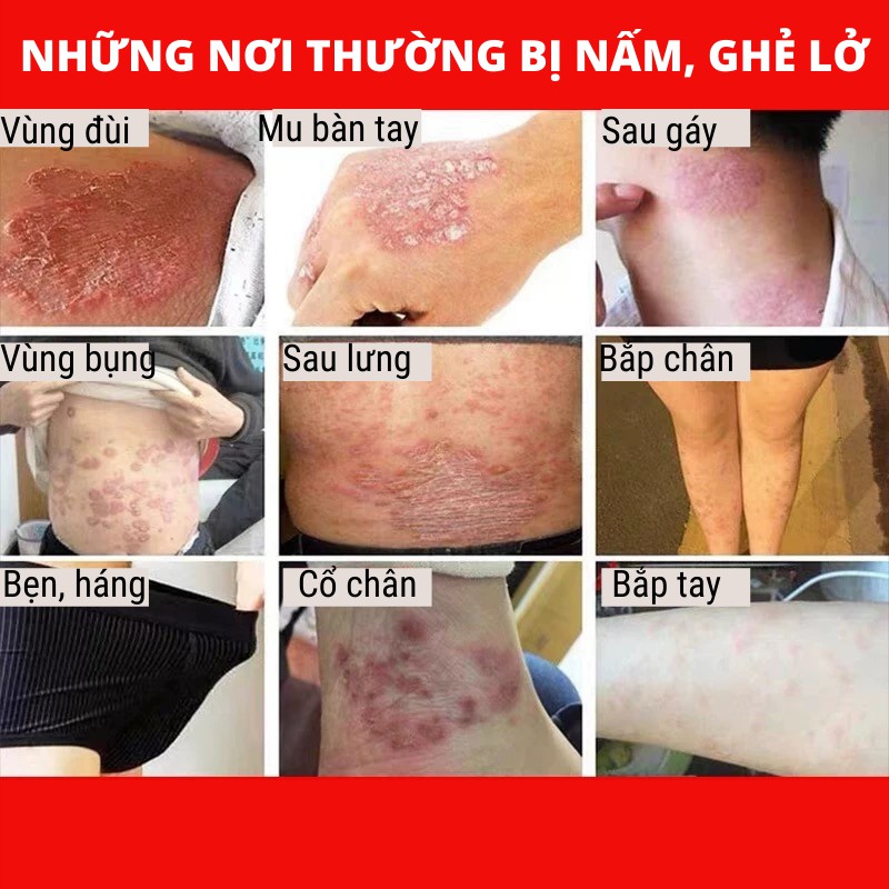 Khỏi 100% ghẻ lở, viêm nấm da, nước ăn chân tay - Kem da liễu Đông y gia truyền Thông Cát (Since 1918)