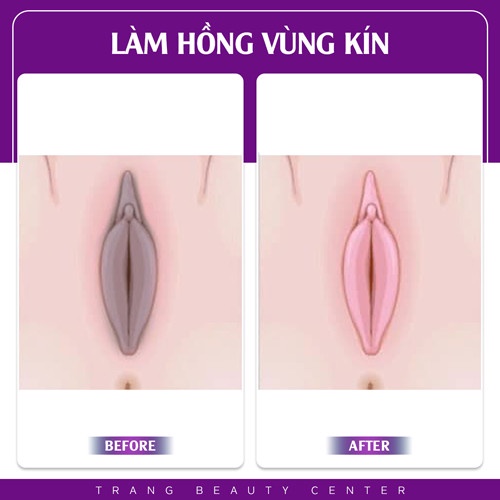 Tinh Chất Hết Thâm Làm Hồng Vùng Kín dành cho nam và nữ