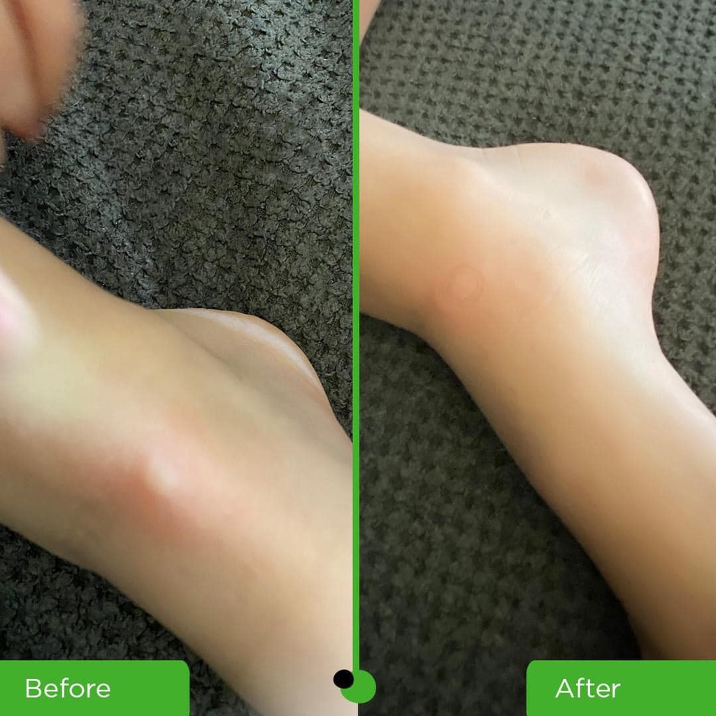 Bug Bite Thing dụng cụ hút nọc độc muối đốt hết ngứa sưng châm chích ngay sau khi hút