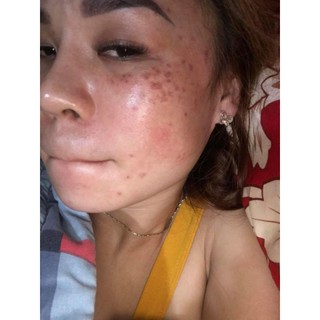 SÉT LẺ TCA CHẤM TÀN NHAN, SẸO RỔ