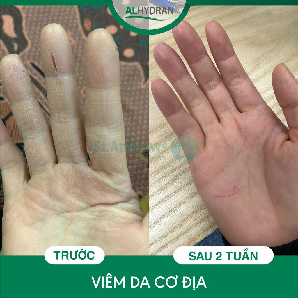 Kem dưỡng ẩm giảm kích ứng da, cải thiện viêm da cơ địa Alhydran 15ml