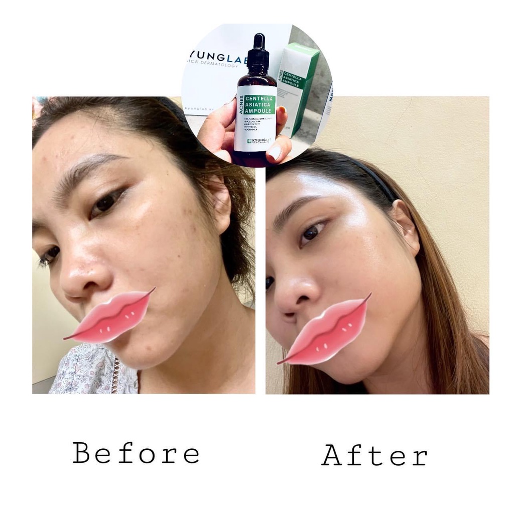 Tinh Chất Serum Giả.m Mụn, Ng.ừa Mụn Kyung Lab Acnes Centella Asiatica Ampoule 50ml