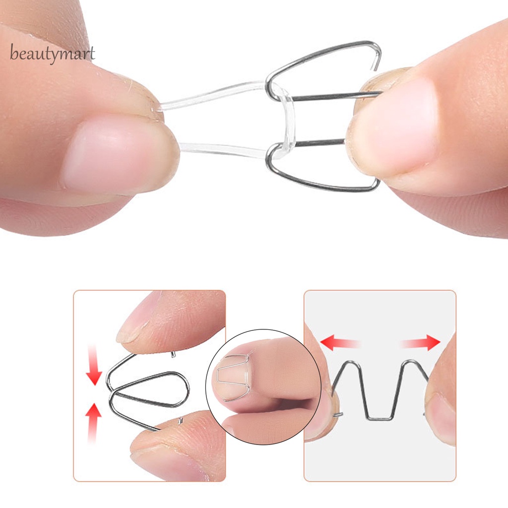 [Hàng mới về] Dụng cụ hỗ trợ điều chỉnh móng chân mọc ngược dễ dàng