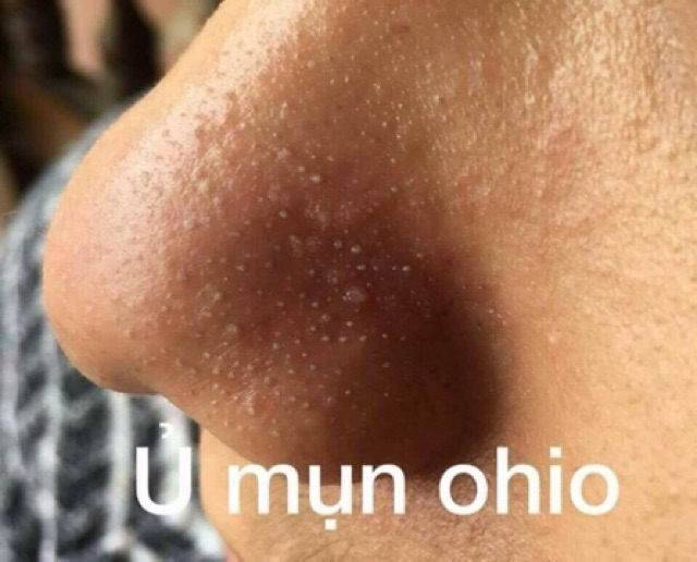 Ủ mụn Ohio - hàng việt nam chất lượng cao 