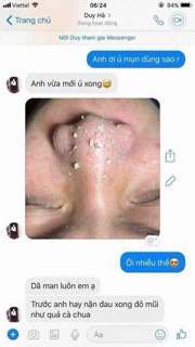 Ủ mụn youngerc ( hình thật trên)