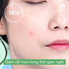 Chấm Mụn Hasi Kokeshi 5ml