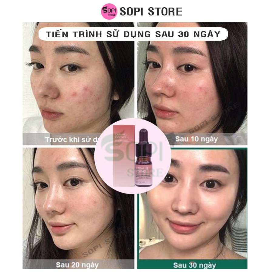 Serum Caramel Essence Nhật Bản 5ml chính hãng, ngừa mụn xoá thâm mụn dưỡng da mụn