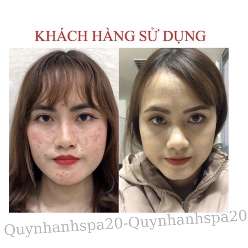 Tinh chất Serum ngăn ngừa mụn làm mờ vết thâm sẹo se khít lỗ chân lông Clear Acne Quyên Lara 12Ml Quynhanhspa