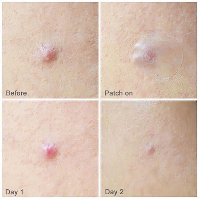 Miếng Dán Ngăn ngừa Mụn Some By Mi Clear Spot Patch