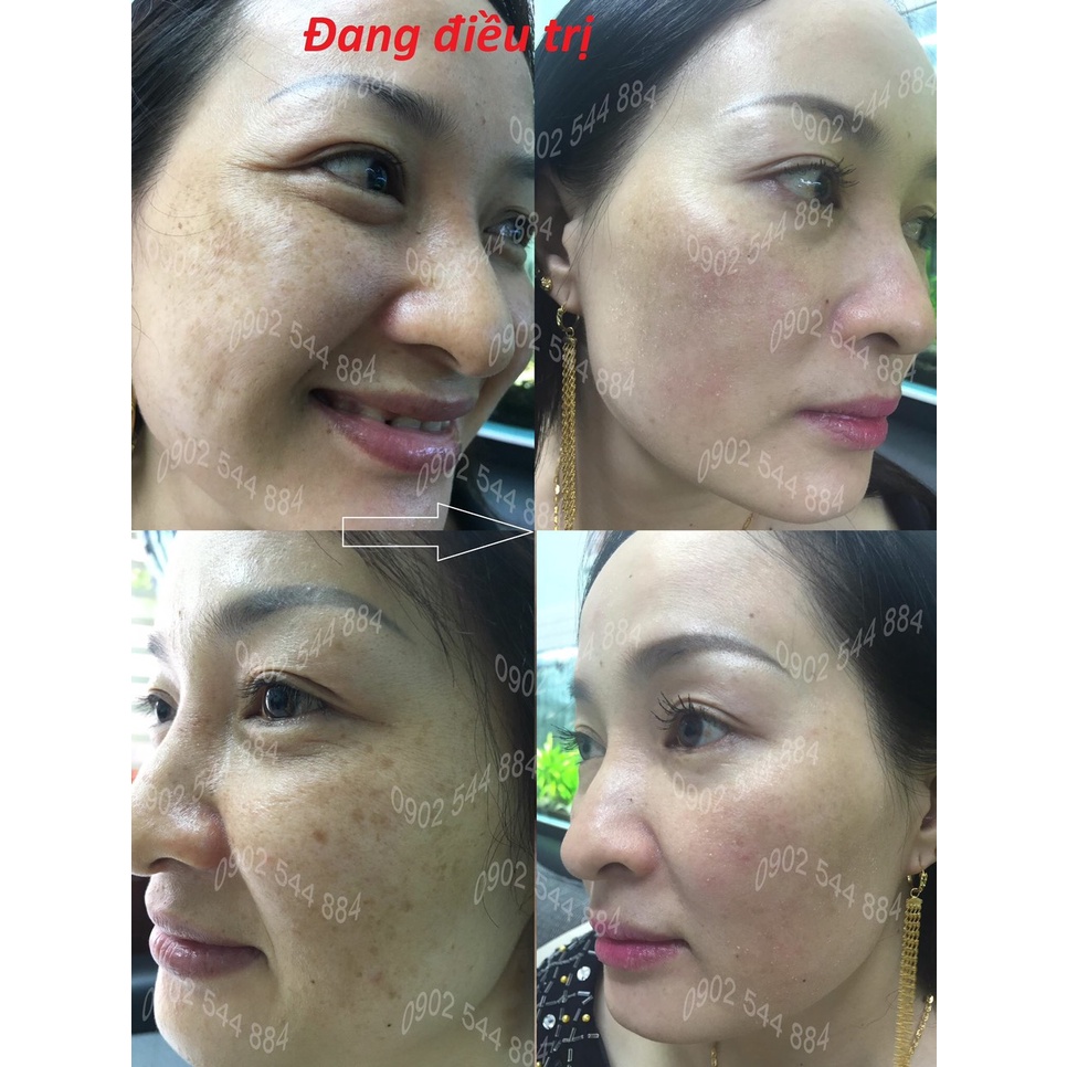 Serum nám Hoàng Trinh