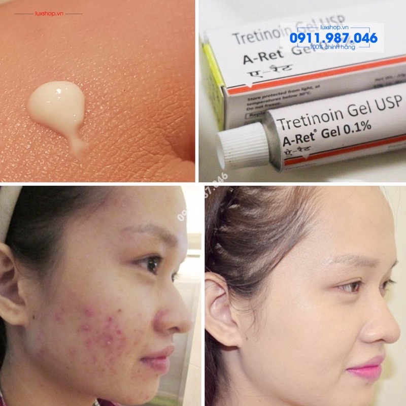 Tretinoin Ấn Aret USP Menarini Giảm Mụn Nám Tái Tạo Da Tre 0.025 0.05 0.1