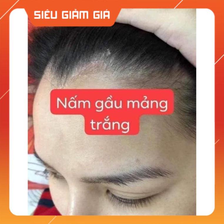 Kem bôi da kem bôi tổ đỉa ghẻ nước nấm ngứa các loại, thảo dược tự nhiên
