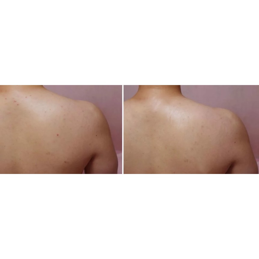 Sữa Dưỡng Thể Chăm Sóc Da Mụn, Mờ Thâm, Dưỡng Trắng Cho Cơ Thể Tiam Anti-Blemish | BigBuy360 - bigbuy360.vn