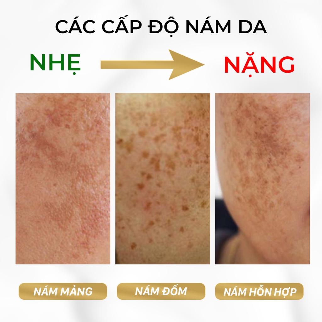 Bộ Kem Nám Tàn Nhang, Dưỡng Trắng, Mờ Thâm, Gồm Kem Oriskin Melasma Whitening Cream Và Serum Oriskin White Skin Serum.