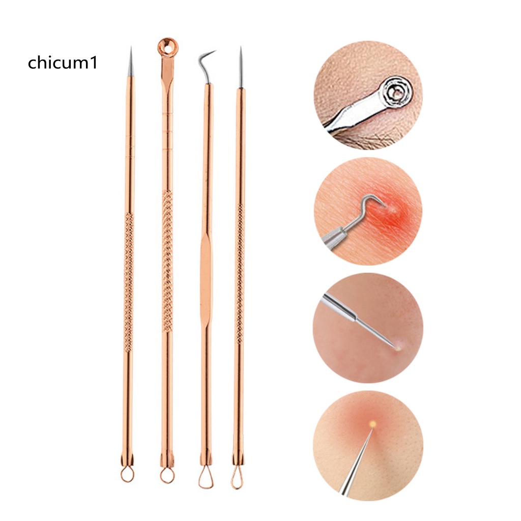 Set 4 Dụng Cụ Nặn Mụn Đầu Đen An Toàn Tiện Dụng